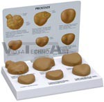 Human Male Prostate Anatomy Model with Patient Education Card